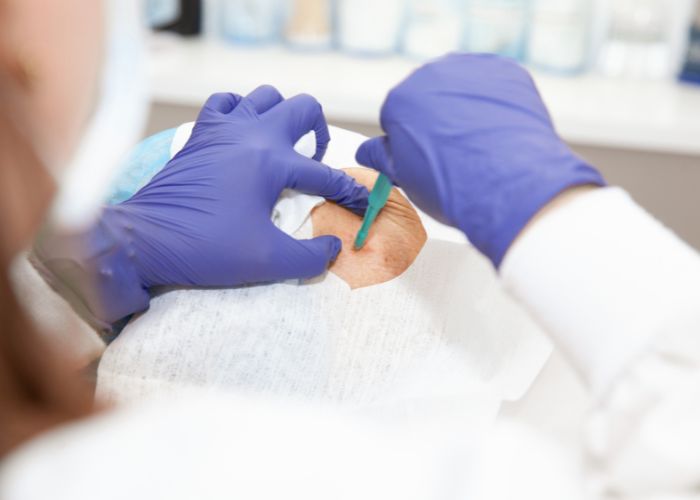 Nyra Clinic - Surgical Dermatology - Biopsy