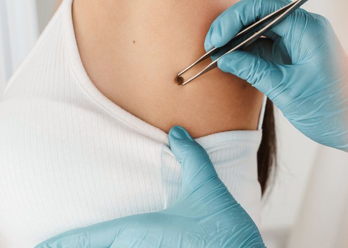 Nyra Clinic - Surgical Dermatology - Wart removal