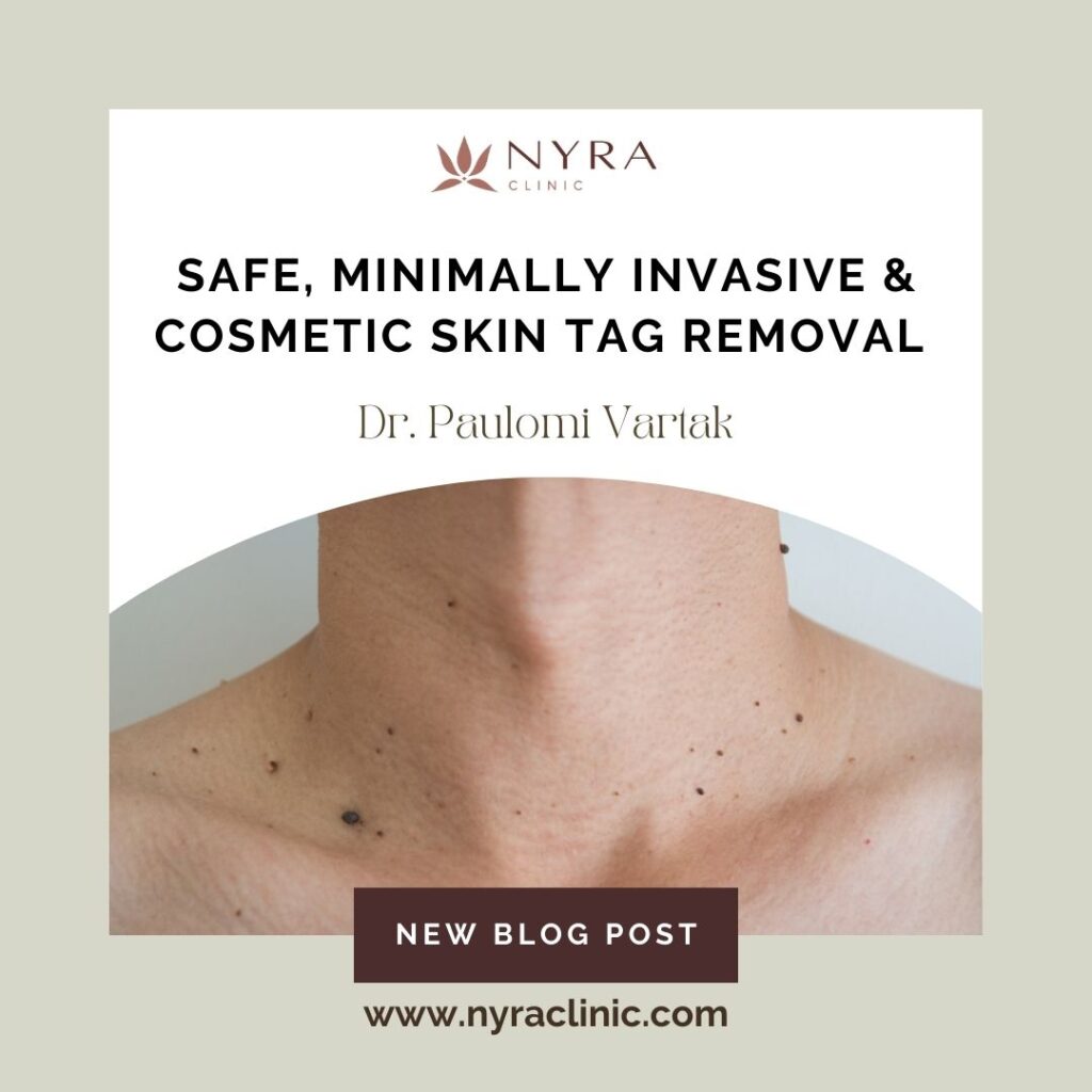 Skin Tag Removal in Pune & Baner Nyra Clinic – Dr. Paulomi Vartak