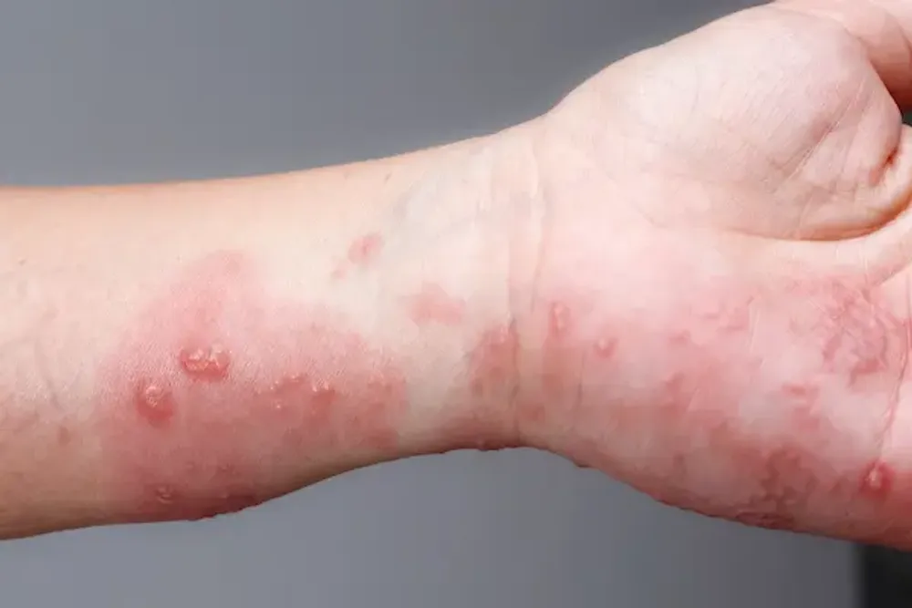 Parasitic Skin Infections In Baner