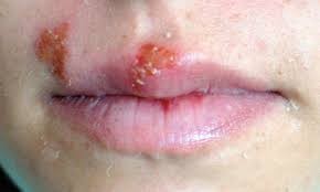 Viral Skin Infections Treatment In Baner