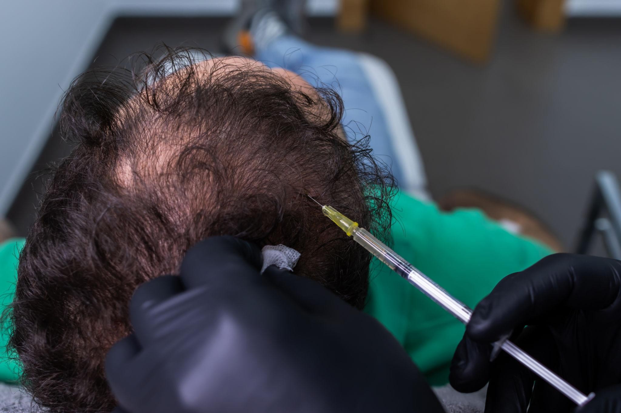 hair loss treatment Pune dermatologist