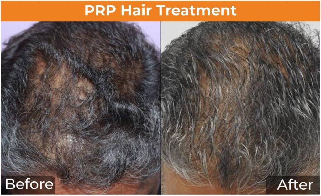 skin rejuvenation PRP Pune